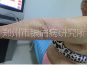抗癣9年，终于康复了