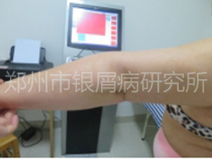 抗癣9年，终于康复了