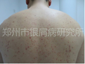 抗癣9年，终于康复了