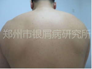 【无声感恩】摆脱银屑病，年轻小伙又获幸福