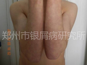 脱掉“癣衣”，他终于昂首挺胸