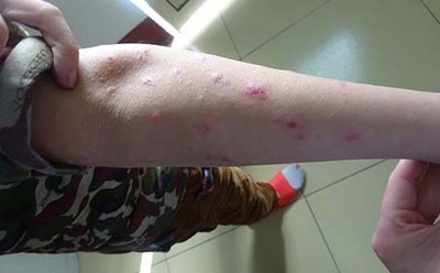 牛皮癣患者如何治疗呢